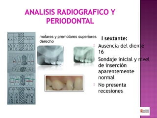 molares y premolares superiores
derecho





I sextante:
Ausencia del diente
16
Sondaje inicial y nivel
de inserción
aparentemente
normal
No presenta
recesiones

 