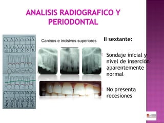 II sextante:

Caninos e incisivos superiores


Sondaje inicial y
nivel de inserción
aparentemente
normal



No presenta
recesiones

 