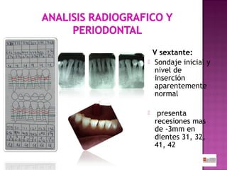



V sextante:
Sondaje inicial y
nivel de
inserción
aparentemente
normal
presenta
recesiones mas
de -3mm en
dientes 31, 32,
41, 42

 