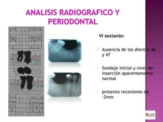 VI sextante:


Ausencia de los dientes 46
y 47



Sondaje inicial y nivel de
inserción aparentemente
normal



presenta recesiones de
-2mm

 
