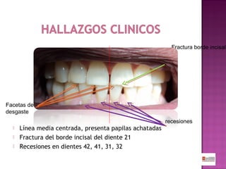 Fractura borde incisal

Facetas de
desgaste
recesiones




Línea media centrada, presenta papilas achatadas
Fractura del borde incisal del diente 21
Recesiones en dientes 42, 41, 31, 32

 