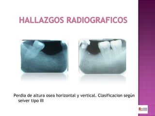 Perdia de altura osea horizontal y vertical. Clasificacion según
seiver tipo III

 