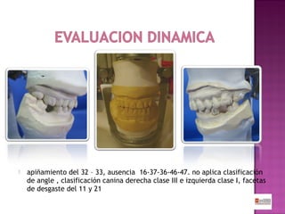 

apiñamiento del 32 – 33, ausencia 16-37-36-46-47. no aplica clasificación
de angle , clasificación canina derecha clase III e izquierda clase I, facetas
de desgaste del 11 y 21

 