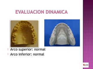 


Arco superior: normal
Arco inferior: normal

 