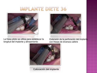 La fresa piloto se utiliza para establecer la
longitud del implante y alineamiento

Extensión de la perforación del implante
con fresas de diversos calibre

Colocación del implante

 