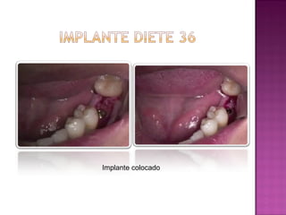 Implante colocado

 