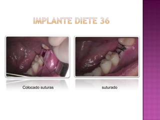 Colocado suturas

suturado

 