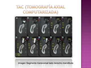 Imagen Segmento transversal lado derecho mandibula

 