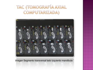 Imagen Segmento transversal lado izquierdo mandibula

 