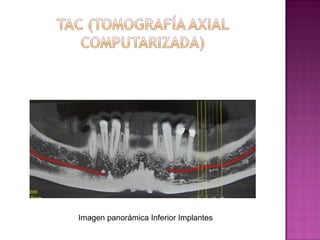 Imagen panorámica Inferior Implantes

 