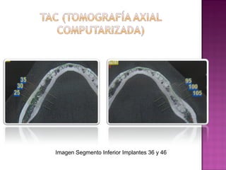 Imagen Segmento Inferior Implantes 36 y 46

 