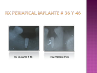 Rx implante # 46

RX implante # 36

 