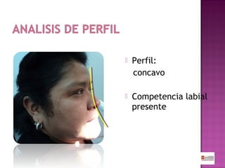 

Perfil:
concavo



Competencia labial
presente

 