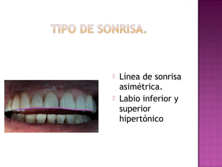 


Línea de sonrisa
asimétrica.
Labio inferior y
superior
hipertónico

 