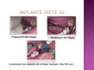 Caso definitivoo implante diente 36 y diente 37 