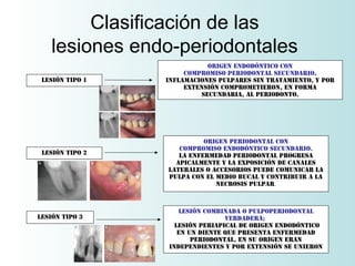 Clasificación de las
    lesiones endo-periodontales
                            origen endodóntico con
                      compromiso periodontal secundario.
 Lesión tipo 1   Inflamaciones Pulpares sin tratamiento, y por
                      extensión comprometieron, en forma
                          secundaria, al periodonto.




                           origen periodontal con
                    compromiso endodóntico secundario.
 Lesión tipo 2      La enfermedad periodontal progresa
                   apicalmente y la exposición de canales
                 laterales o accesorios puede comunicar la
                 pulpa con el medio bucal y contribuir a la
                              necrosis pulpar.



                    lesión combinada o pulpoperiodontal
Lesión tipo 3                    verdadera;
                   lesión periapical de origen endodóntico
                    en un diente que presenta enfermedad
                        periodontal. En su origen eran
                 independientes y por extensión se unieron
 