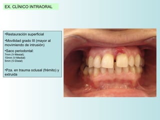 EX. CLÍNICO INTRAORAL




•Restauración superficial
•Movilidad grado III (mayor al
movimiendo de intrusión)
•Saco periodontal:
7mm (V-Mesial);
10mm (V-Medial)
5mm (V-Distal)


•Pza. en trauma oclusal (frémito) y
extruida
 