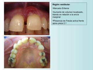 Región vestibular:
               •Marcado Eritema
               •Aumento de volumen localizado,
               blando en relación a la encía
               marginal
               •Presencia de Fístula activa frente
               apice pieza 2.1




Restauración
RC Mesial
superficial
 
