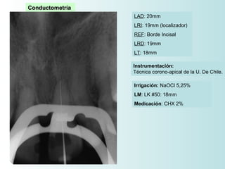 Conductometría
                 LAD: 20mm
                 LRI: 19mm (localizador)
                 REF: Borde Incisal
                 LRD: 19mm
                 LT: 18mm

                 Instrumentación:
                 Técnica corono-apical de la U. De Chile.

                 Irrigación: NaOCl 5,25%
                 LM: LK #50: 18mm
                 Medicación: CHX 2%
 