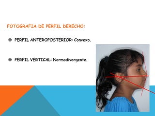 FOTOGRAFIA DE PERFIL DERECHO:


 PERFIL ANTEROPOSTERIOR: Convexo.



 PERFIL VERTICAL: Normodivergente.
 