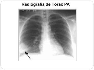 Radiografia de Tórax PA
 