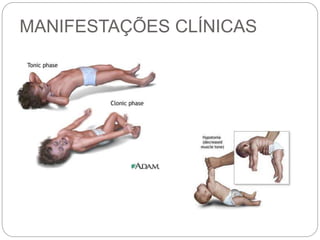 MANIFESTAÇÕES CLÍNICAS
 