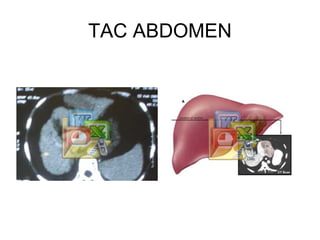 TAC ABDOMEN 