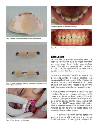Discussão
O uso de aparelhos mantenedores de
espaço removíveis para crianças menores
de cinco anos não é muito recomendado
pela falta de cooperação do paciente.
Assim, o uso de aparelhos fixos torna-se a
opção mais indicada nesses casos.
Outro problema encontrado na confecção
desses aparelhos é que o mesmo seja
compatível com o crescimento maxilar da
criança. Visando isto, Denari et al., 1995,
criaram um aparelho baseado no sistema
tubo-barra, permitindo este crescimento.
Vários autores defendem a utilização dos
mantenedores de espaço, principalmente
quando a criança está em desenvolvimento
fonético, para que este não seja prejudicado
pela perda desses dentes (Saini et al., 2001;
Diniz et al., 2005). Além disso, há relatos
que o comprometimento estético afeta a
relação social da criança nesta etapa em
que ela inicia a vida escolar.
	 A devolução de um sorriso agradável
para a criança, além da sua importância
funcional quanto à mastigação, deglutição
Figura 3. Modelo com a prótese fixa em posição. Vista palatina.
Figura 6. Adaptação da face palatina da peça.
Figura 7. Aspecto final – após cimentação da peça.
Figura 5. Prova da peça – pré-cimentação.
Figura 4. Prótese fixa anterior de Denari – ilustração da liberdade de mov-
imento entre os elementos.
 