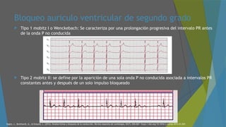 CASO INTERESANTE bloqueo auriculo ventricular .pptx