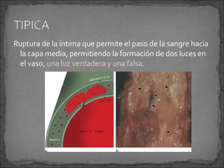 Ruptura de la íntima que permite el paso de la sangre hacia
la capa media, permitiendo la formación de dos luces en
el vaso, una luz verdadera y una falsa.

 