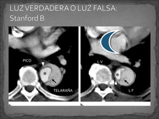 PICO

LV

TELARAÑA

LF

 