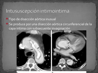Tipo de disección aórtica inusual
Se produce por una disección aórtica circunferencial de la

capa intima con subsecuente invaginación

 