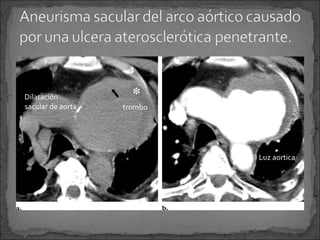 Dilatación
sacular de aorta

trombo

Luz aortica

 