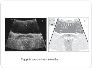 Vejiga de características normales 