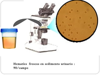 Hematíes  frescos en sedimento urinario :  90/campo 