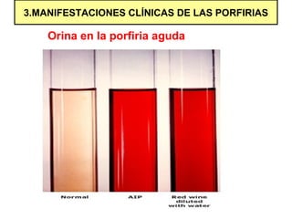 3.MANIFESTACIONES CLÍNICAS DE LAS PORFIRIAS

    Orina en la porfiria aguda
 