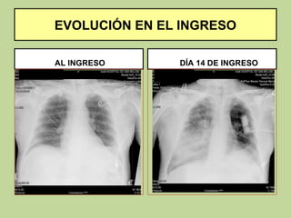 EVOLUCIÓN EN EL INGRESO

AL INGRESO     DÍA 14 DE INGRESO
 