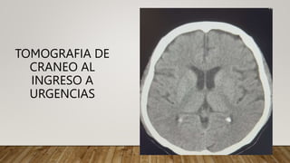 TOMOGRAFIA DE
CRANEO AL
INGRESO A
URGENCIAS
 
