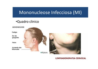 Mononucleose Infecciosa (MI) 
•Quadro clinico 
 