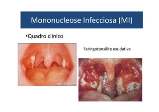 Mononucleose Infecciosa (MI) 
Faringotonsilite exudativa 
•Quadro clinico 
 