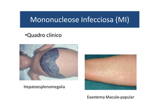 Mononucleose Infecciosa (MI) 
•Quadro clinico 
Hepatoesplenomegalia 
Exantema Maculo-papular 
 