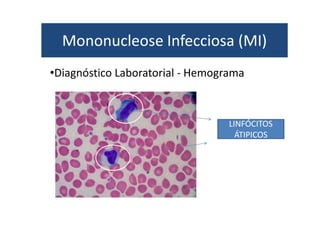 Mononucleose Infecciosa (MI) 
•Diagnóstico Laboratorial - Hemograma 
LINFÓCITOS 
ÁTIPICOS 
 