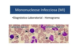 Mononucleose Infecciosa (MI) 
•Diagnóstico Laboratorial - Hemograma 
 