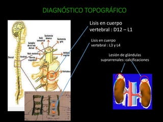 DIAGNÓSTICO TOPOGRÁFICO
Lisis en cuerpo
vertebral : L3 y L4
Lesión de glándulas
suprarrenales: calcificaciones
Lisis en cuerpo
vertebral : D12 – L1
 