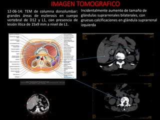 12-06-14: TEM de columna dorsolumbar:
grandes áreas de esclerosis en cuerpo
vertebral de D12 y L1, con presencia de
lesión lítica de 15x9 mm a nivel de L1.
Incidentalmente aumento de tamaño de
glándulas suprarrenales bilaterales, con
gruesas calcificaciones en glándula suprarrenal
izquierda
IMAGEN TOMOGRAFICO
 