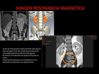 IMAGEN RESONANCIA MAGNETICA
25-01-16: Pinzamiento severo derecho del espacio
intervertebral L4 lo que condiciona escoliosis de
concavidad derecha y estenosis del agujero
foraminal L3-L4 derecho de aspecto secuelar no
activo.
Pinzamientos facetarios L4-L5 bilateral y L3-L4
izquierdo correlacionar con datos clínicos.
 