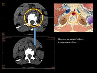 Absceso paravertebral más
lesiones osteolíticas.
 