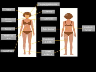 Parestesias
de MMII
Dolor lumbar
Escoliosis
lumbar
Vómitos y
náuseas
Astenia
Fiebre
Anorexia
Marcha
antálgica
Sudoración
Escalofríos
Hiperpigmentación
Pérdida de
peso
 