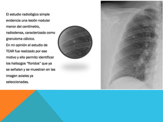 El estudio radiológico simple
evidencia una lesión nodular
menor del centímetro,
radiodensa, caracterizada como
granuloma cálcico.
En mi opinión el estudio de
TCAR fue realizado por ese
motivo y ello permito identificar
los hallazgos “floridos” que ya
se señalan y se muestran en las
imagen axiales ya
seleccionadas.
 