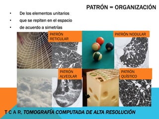 PATRÓN
RETICULAR
•  De los elementos unitarios
•  que se repiten en el espacio
•  de acuerdo a simetrías
PATRÓN = ORGANIZACIÓN
PATRÓN NODULAR
PATRÓN
ALVEOLAR
PATRÓN
QUÍSTICO
T C A R, TOMOGRAFÍA COMPUTADA DE ALTA RESOLUCIÓN
 